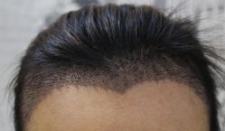 -大麦微针植发丨全国连锁