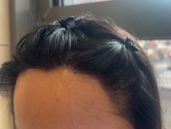 -碧莲盛·不剃发植发