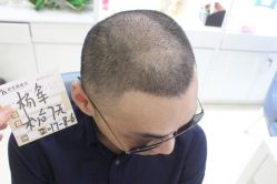 点击看大图 -大麦微针植发丨全国连锁