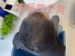 点击看大图 -大麦微针植发全国连锁