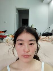 体验后-大麦微针植发丨全国连锁