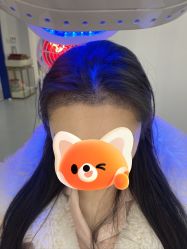 -大麦微针植发全国连锁