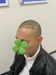 -大麦微针植发全国连锁