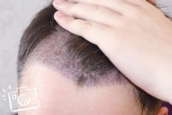 -大麦微针植发丨全国连锁