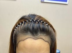 -大麦微针植发全国连锁