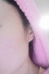 -爱莎扁平疣·汗管瘤·斑痣中心