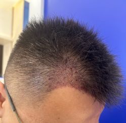 -大麦微针植发全国连锁