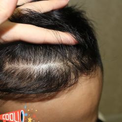 -大麦微针植发丨全国连锁