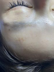 体验前-爱莎扁平疣·汗管瘤·斑痣中心