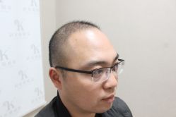 点击看大图 -大麦微针植发丨全国连锁