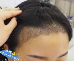 -大麦微针植发丨全国连锁