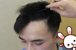 -大麦微针植发丨全国连锁