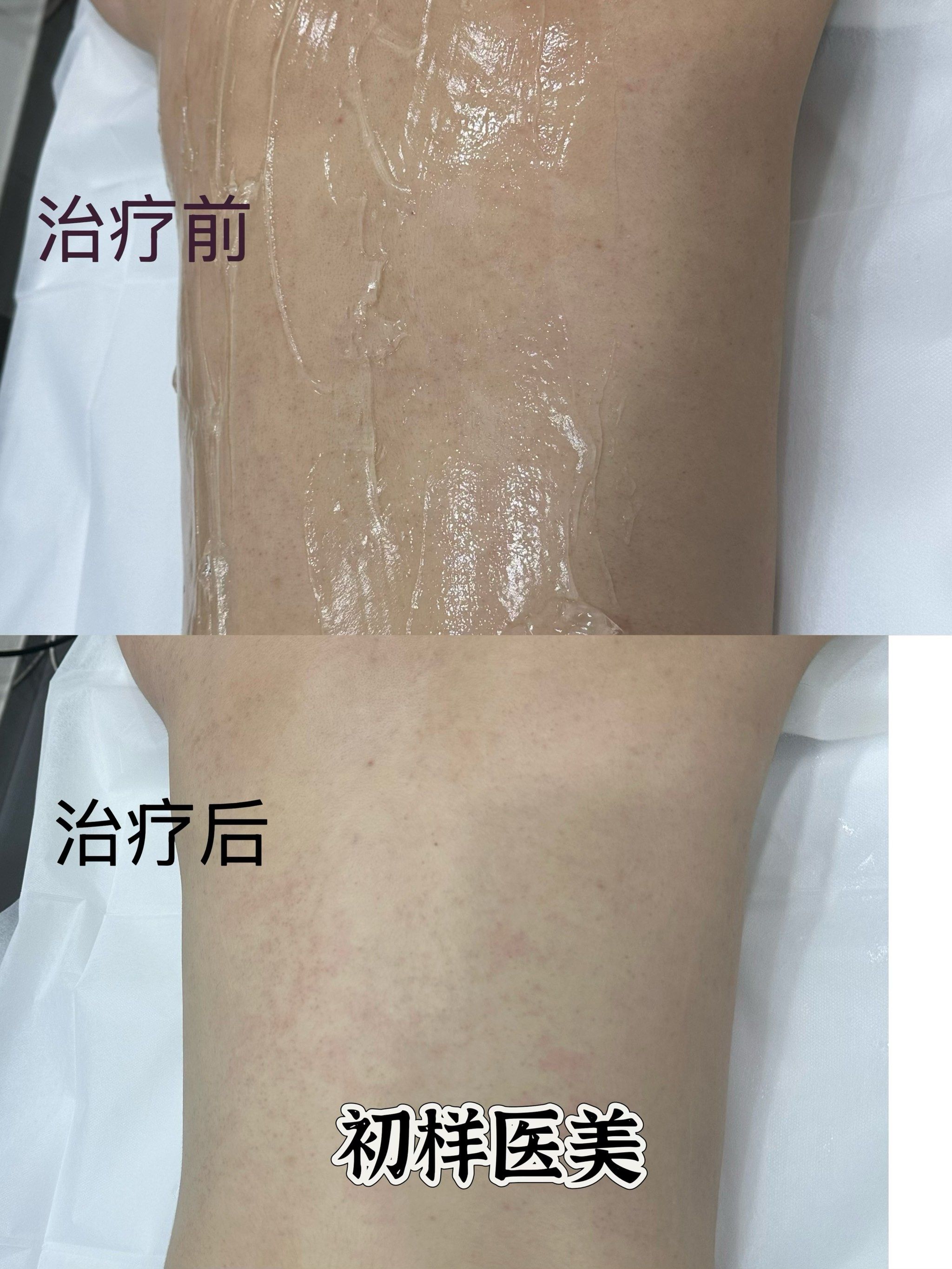 全身美白黑金超光子➕牛奶酸