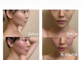 今天体验了一个贫民窟女孩的remaji RET深热塑