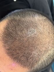 体验后-雍禾植发全国连锁