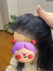 -大麦微针植发全国连锁