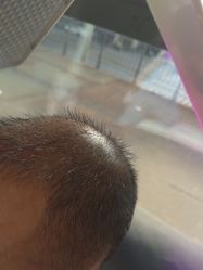 -碧莲盛·不剃发植发