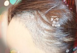 -大麦微针植发全国连锁