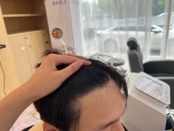 体验后-大麦微针植发丨全国连锁