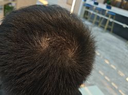-碧莲盛·不剃发植发