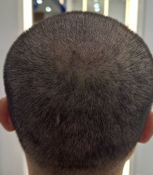 体验后-大麦微针植发全国连锁