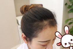 点击看大图 -大麦微针植发丨全国连锁