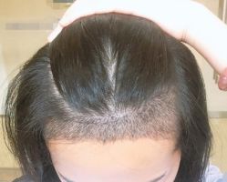 -大麦微针植发全国连锁