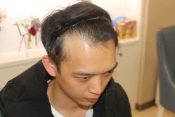 点击看大图 -大麦微针植发丨全国连锁