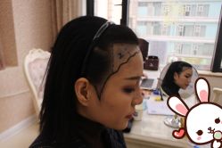 -大麦微针植发丨全国连锁