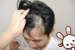 点击看大图 -大麦微针植发丨全国连锁