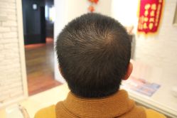 点击看大图 -大麦微针植发丨全国连锁