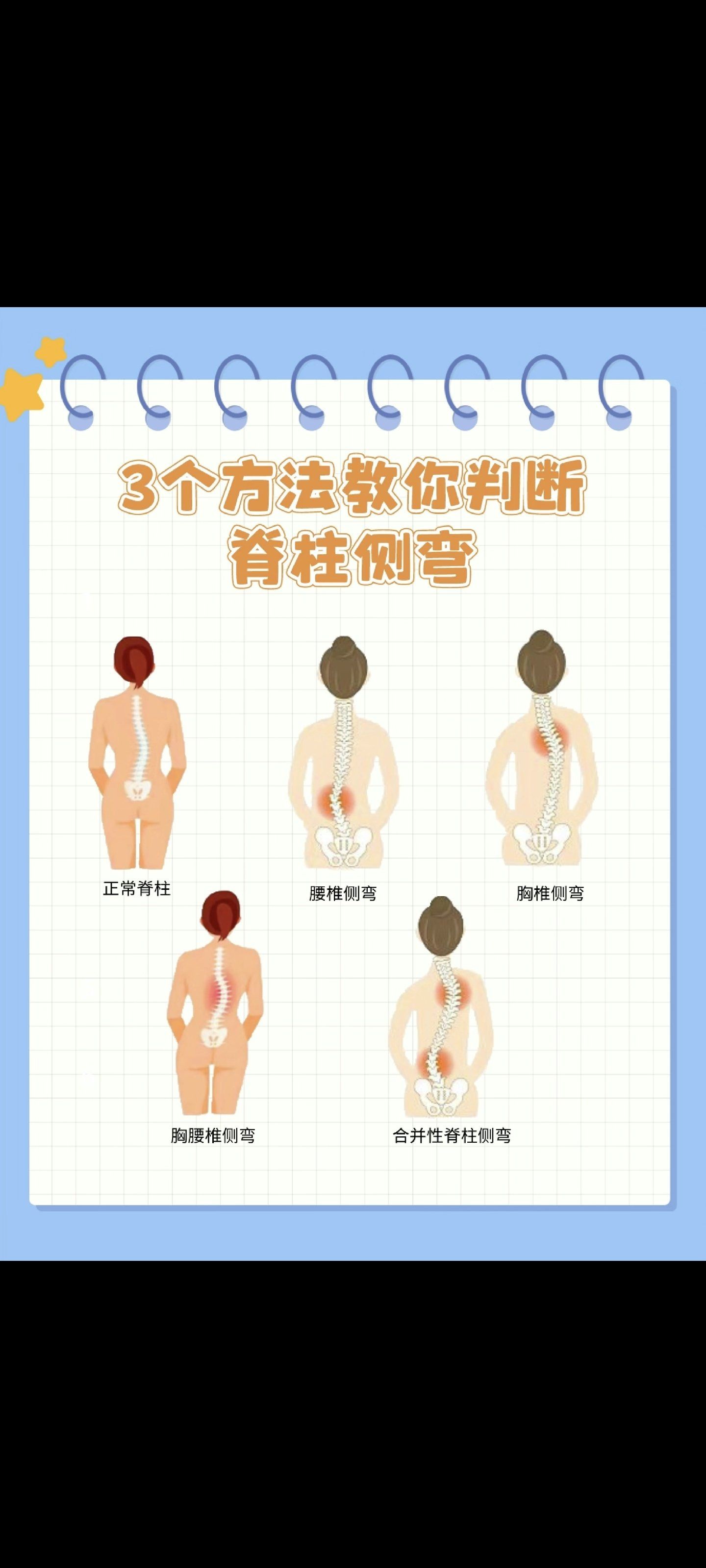 脊柱侧弯教你三个方法自测