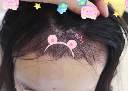 -大麦微针植发全国连锁