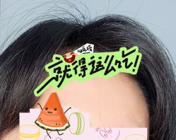 -大麦微针植发全国连锁