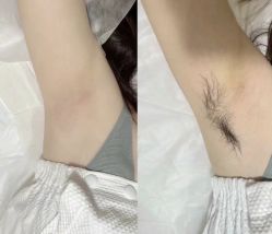 -薇兰专业脱毛连锁机构