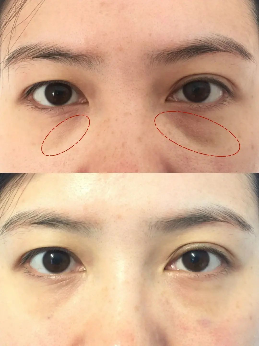 我和泪沟和解了,改善提升拯救垮眼