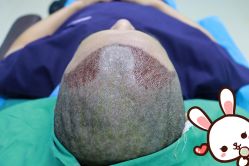 -大麦微针植发丨全国连锁