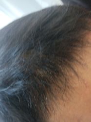 -碧莲盛·不剃发植发