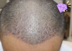 -大麦微针植发丨全国连锁