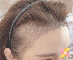 -大麦微针植发丨全国连锁