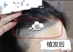 -大麦微针植发全国连锁