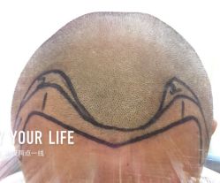 -大麦微针植发全国连锁