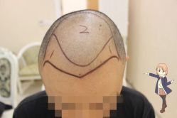 -大麦微针植发丨全国连锁