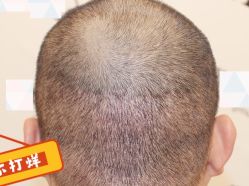 -大麦微针植发全国连锁