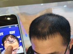 -碧莲盛·不剃发植发