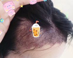 -大麦微针植发全国连锁