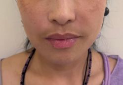 -海涛医疗美容·面部抗衰·注射美鼻