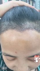 -大麦微针植发丨全国连锁