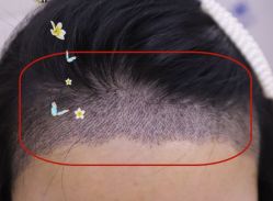 -大麦微针植发全国连锁