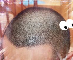 -大麦微针植发全国连锁